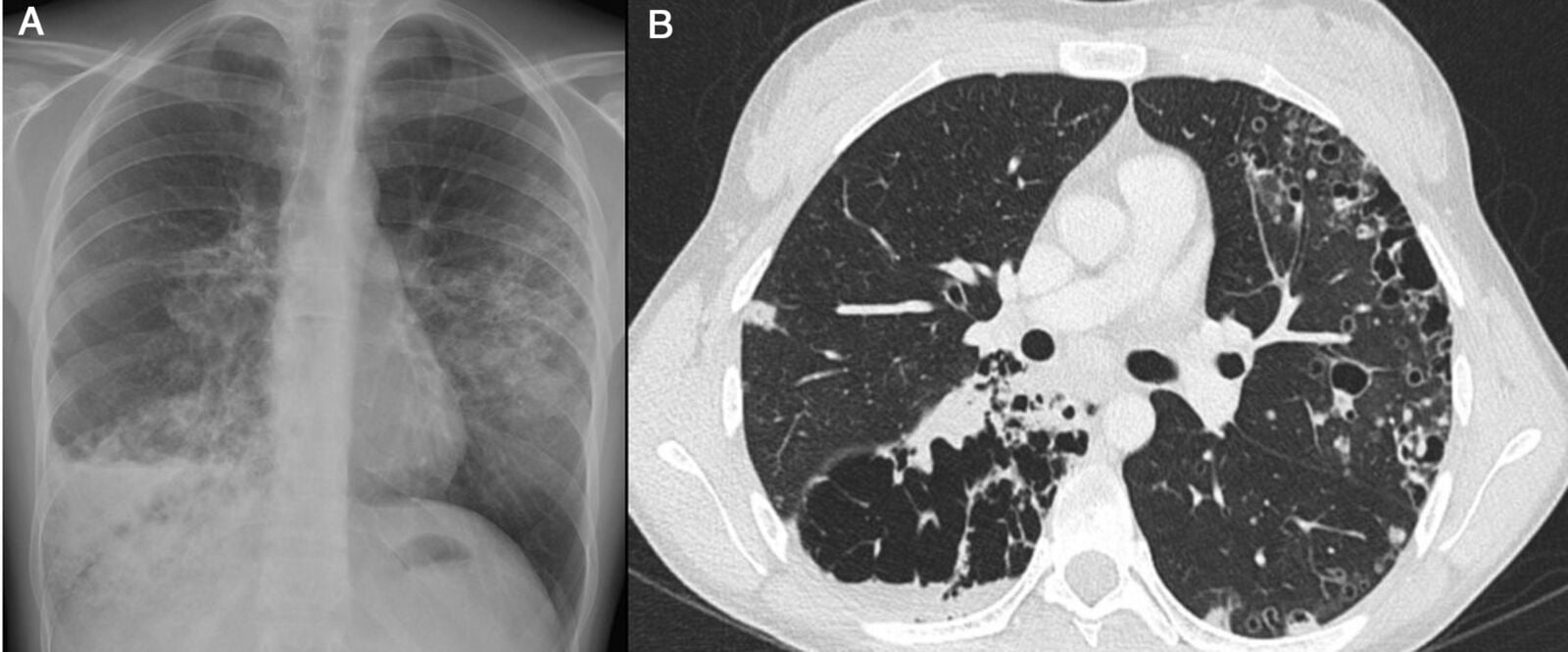 Adenocarcinoma pulmonar: qué es y cómo se diagnostica