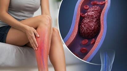 Trombosis en mujeres: factores de riesgo y prevención