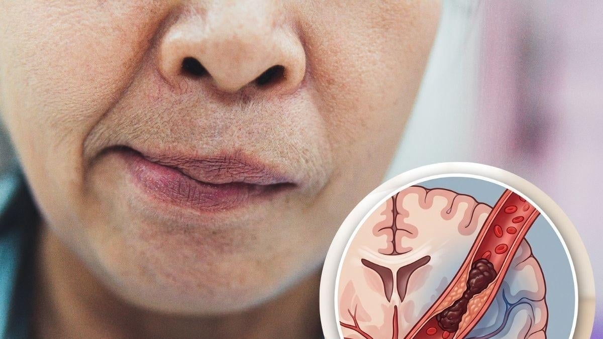ACV isquémico: tratamientos que pueden salvar vidas
