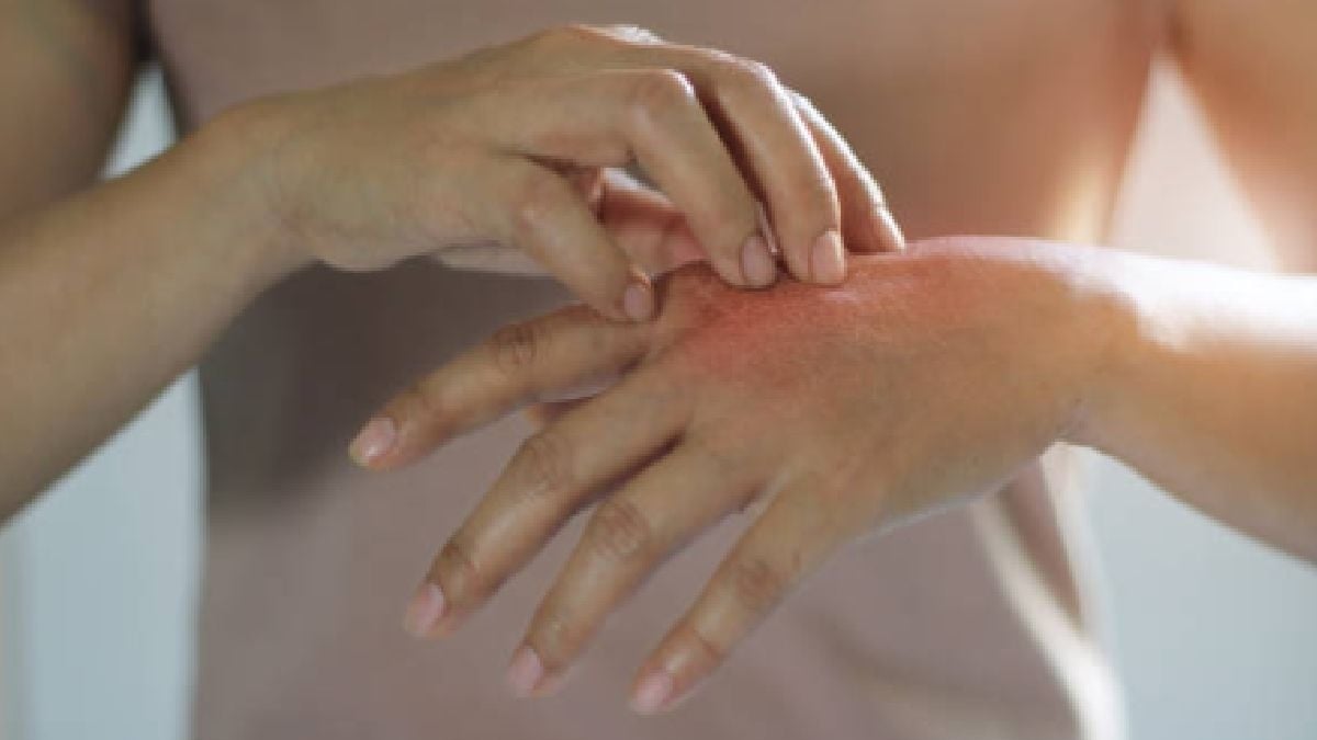 Psoriasis: una enfermedad que también afecta la salud emocional