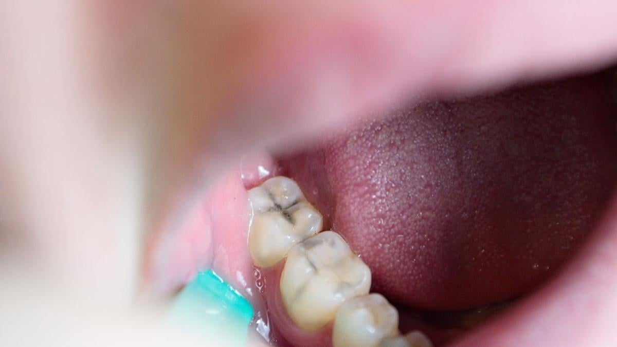 Fluoruro de diamina de plata: un tratamiento que puede detener las caries infantiles 