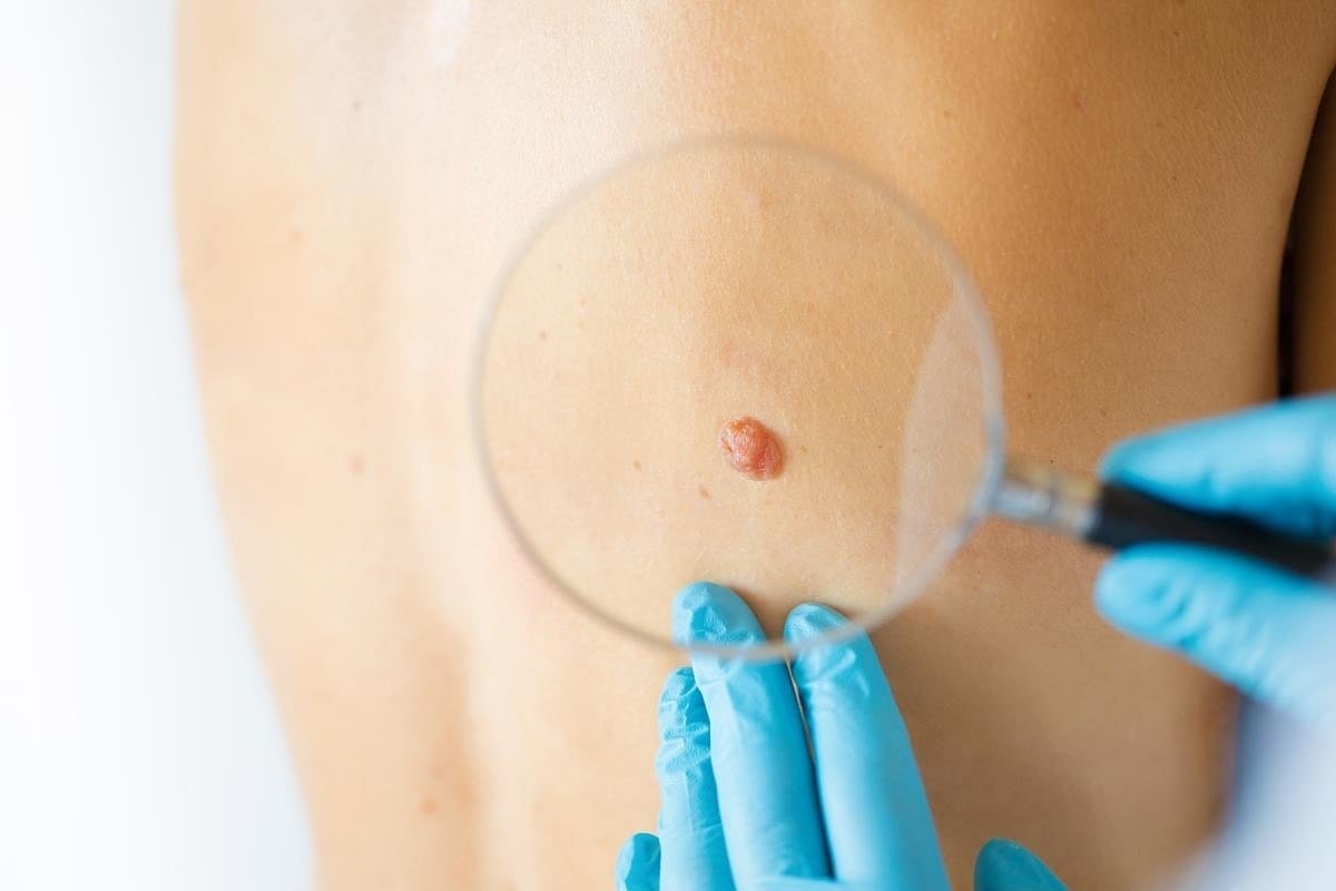 Vacuna personalizada contra el melanoma reduce un 42 % el riesgo de recaída o muerte