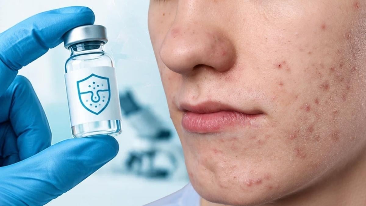 Vacunas contra el acné: nuevas estrategias buscan reducir la inflamación