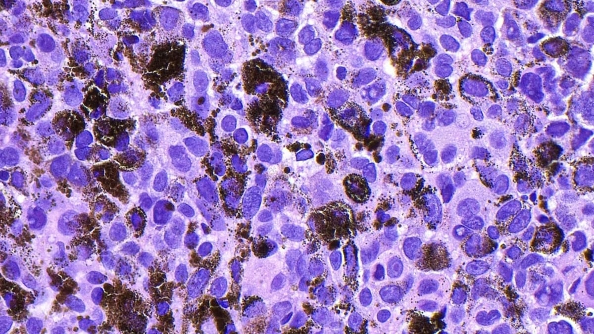Vacuna personalizada de ARNm contra el melanoma reduce 42% el riesgo de recaída